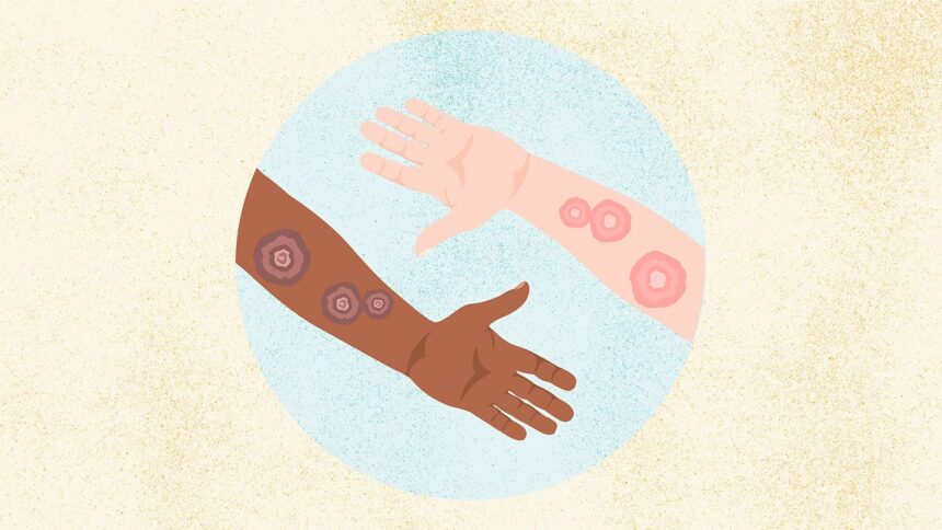 What Is Ringworm? Symptoms, Causes, Diagnosis, Treatment, and Prevention