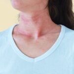 Why a Detox Diet Can Cause a Rash — and What to Do if It Happens