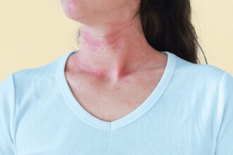 Why a Detox Diet Can Cause a Rash — and What to Do if It Happens