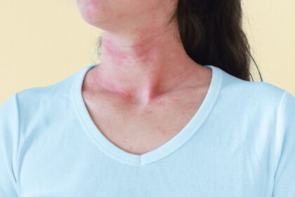 Why a Detox Diet Can Cause a Rash — and What to Do if It Happens