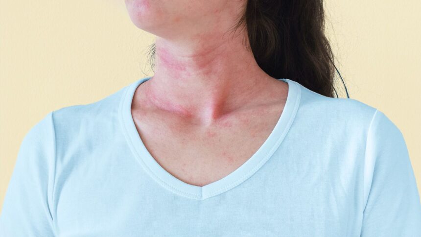 Why a Detox Diet Can Cause a Rash — and What to Do if It Happens