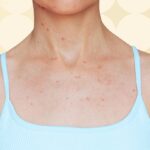 5 Places Body Acne Can Show Up and What to Do About It