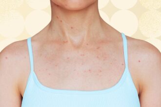 5 Places Body Acne Can Show Up and What to Do About It