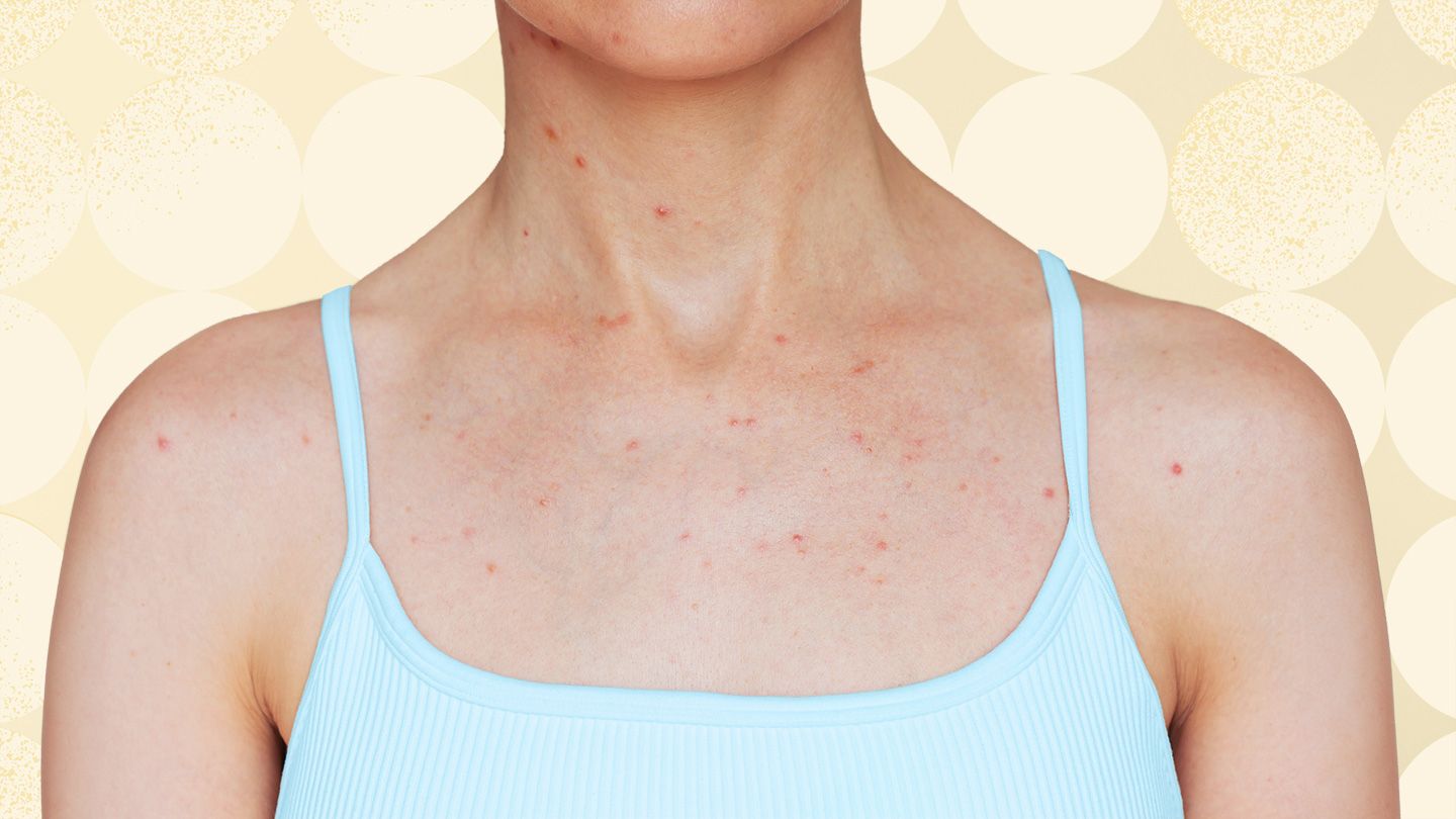 5 Places Body Acne Can Show Up and What to Do About It